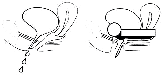 urethra pesar - n�vod